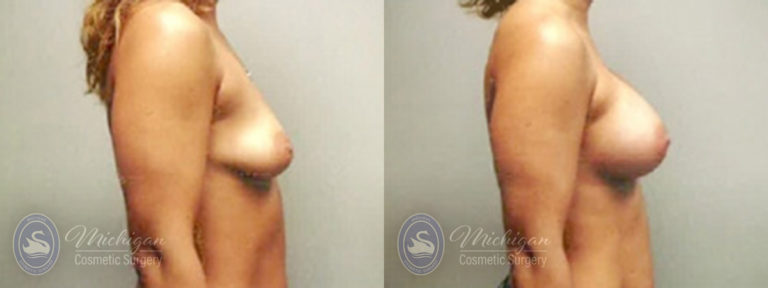 Breast Augmentation with Small Lift Before and After Photo by Dr. Awada in Southfield Michigan
