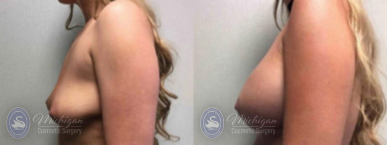 Breast Augmentation with Small Lift Before and After Photo by Dr. Awada in Southfield Michigan