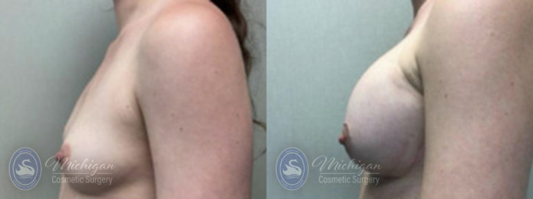 Breast Augmentation with Small Lift Before and After Photo by Dr. Awada in Southfield Michigan