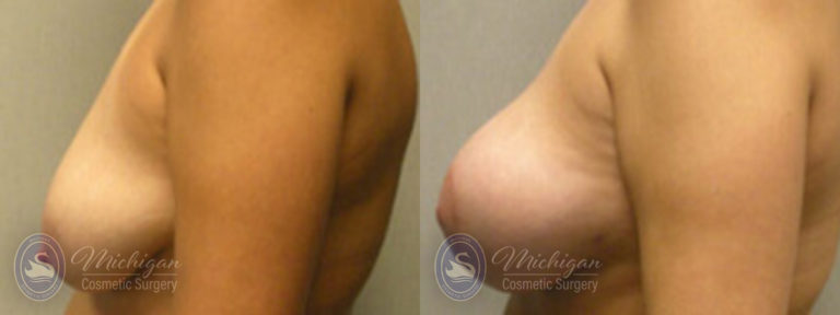 Breast Augmentation with Small Lift Before and After Photo by Dr. Awada in Southfield Michigan