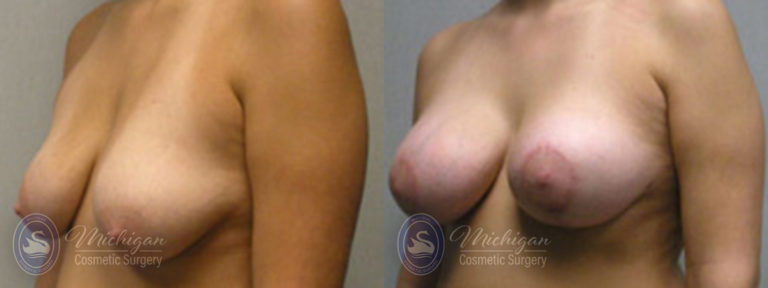 Breast Augmentation with Small Lift Before and After Photo by Dr. Awada in Southfield Michigan