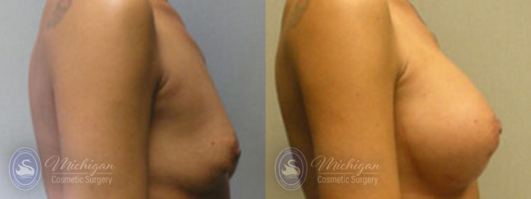 Breast Augmentation with Small Lift Before and After Photo by Dr. Awada in Southfield Michigan