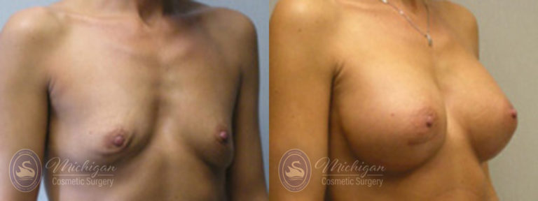Breast Augmentation with Small Lift Before and After Photo by Dr. Awada in Southfield Michigan