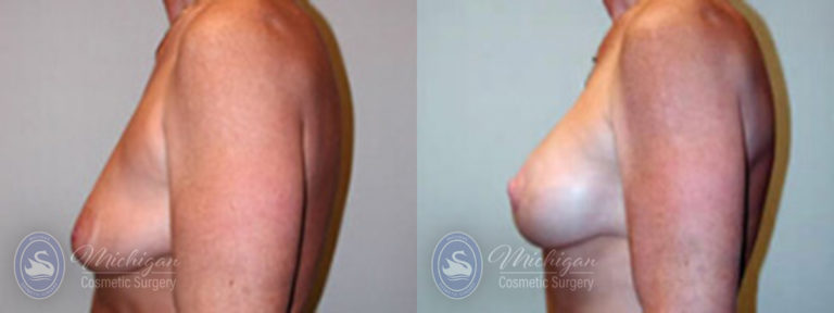 Breast Augmentation with Small Lift Before and After Photo by Dr. Awada in Southfield Michigan