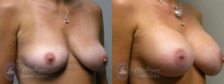Breast Augmentation with Small Lift Before and After Photo by Dr. Awada in Southfield Michigan