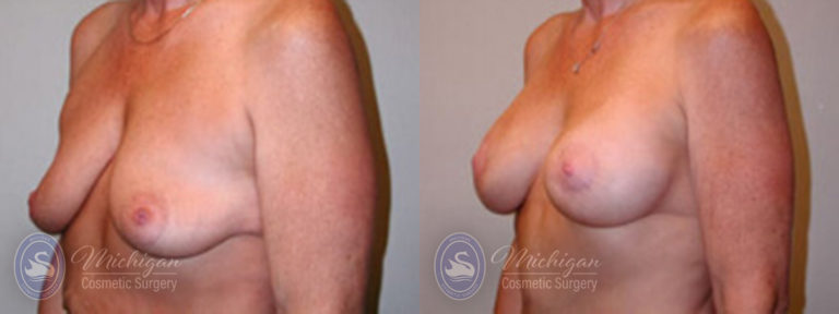 Breast Augmentation with Small Lift Before and After Photo by Dr. Awada in Southfield Michigan