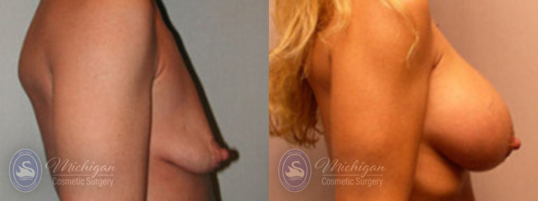 Breast Augmentation with Small Lift Before and After Photo by Dr. Awada in Southfield Michigan