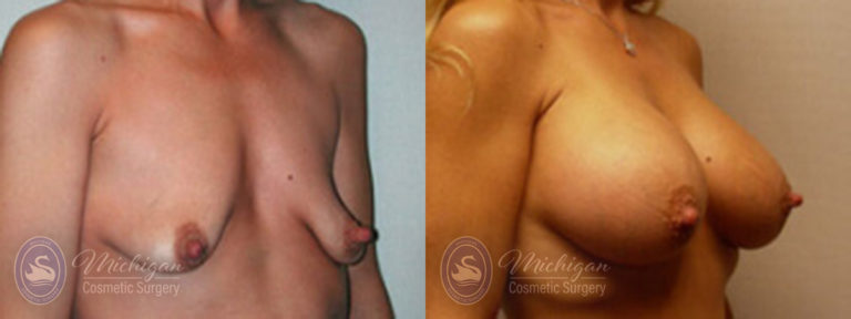 Breast Augmentation with Small Lift Before and After Photo by Dr. Awada in Southfield Michigan