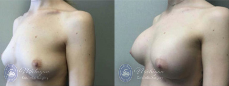 Breast Augmentation with Small Lift Before and After Photo by Dr. Awada in Southfield Michigan