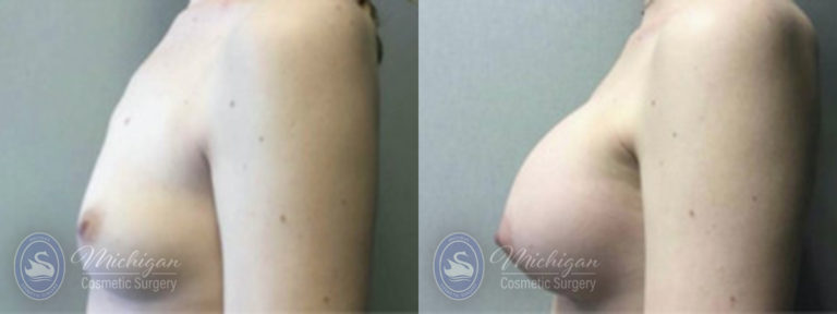 Breast Augmentation with Small Lift Before and After Photo by Dr. Awada in Southfield Michigan
