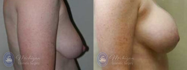 Breast Augmentation with Small Lift Before and After Photo by Dr. Awada in Southfield Michigan