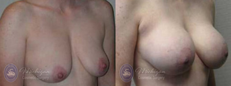 Breast Augmentation with Small Lift Before and After Photo by Dr. Awada in Southfield Michigan
