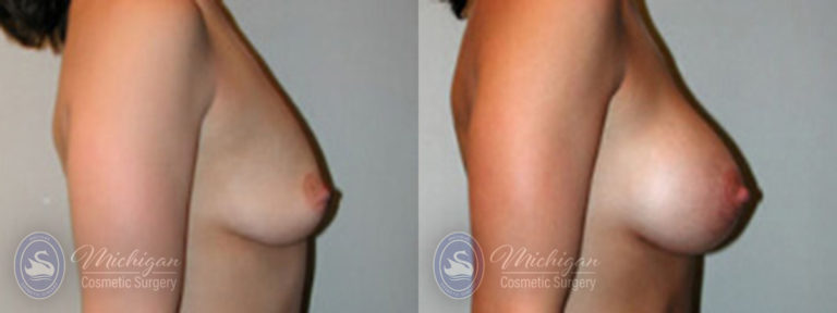 Breast Augmentation with Small Lift Before and After Photo by Dr. Awada in Southfield Michigan
