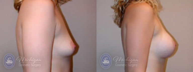 Breast Augmentation Before and After Photo by Dr. Awada in Southfield Michigan