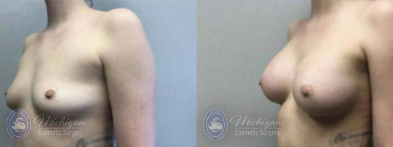 Breast Augmentation Before and After Photo by Dr. Awada in Southfield Michigan