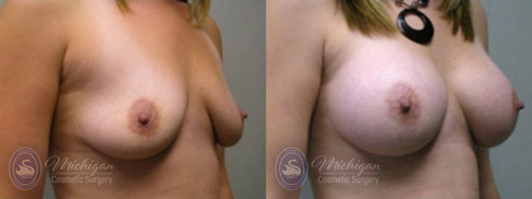 Breast Augmentation Before and After Photo by Dr. Awada in Southfield Michigan
