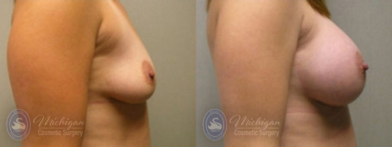 Breast Augmentation Before and After Photo by Dr. Awada in Southfield Michigan