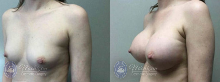 Breast Augmentation Before and After Photo by Dr. Awada in Southfield Michigan