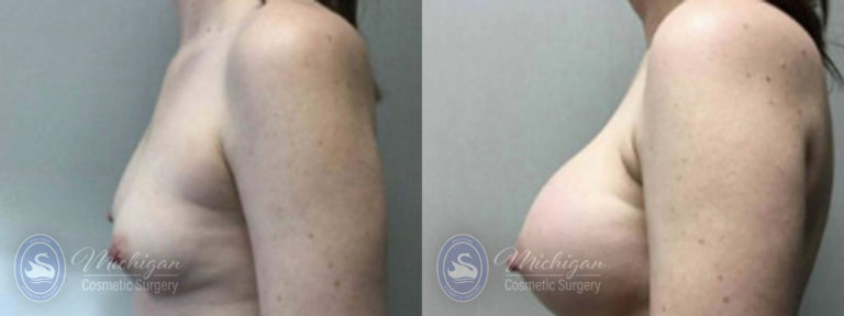 Breast Augmentation Before and After Photo by Dr. Awada in Southfield Michigan