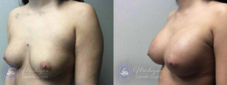 Breast Augmentation Before and After Photo by Dr. Awada in Southfield Michigan
