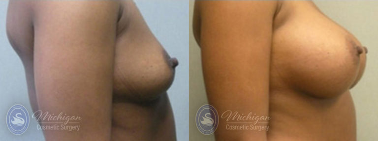 Breast Augmentation Before and After Photo by Dr. Awada in Southfield Michigan