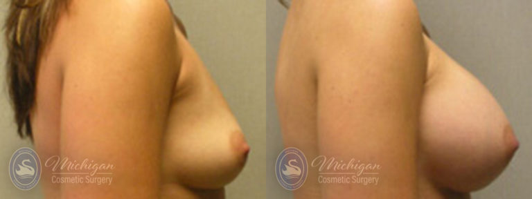 Breast Augmentation Before and After Photo by Dr. Awada in Southfield Michigan