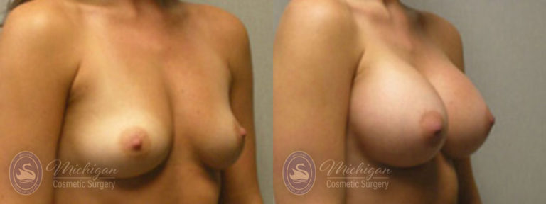 Breast Augmentation Before and After Photo by Dr. Awada in Southfield Michigan
