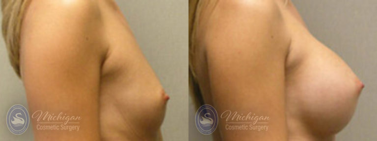 Breast Augmentation Before and After Photo by Dr. Awada in Southfield Michigan