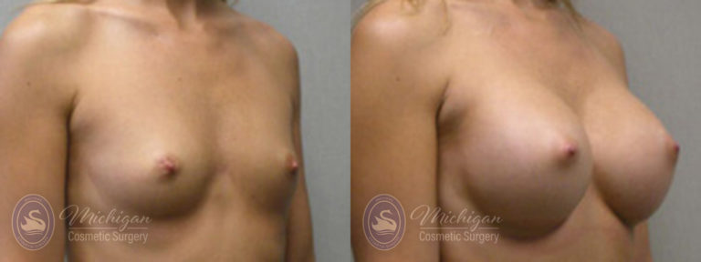 Breast Augmentation Before and After Photo by Dr. Awada in Southfield Michigan