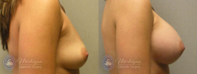 Breast Augmentation Before and After Photo by Dr. Awada in Southfield Michigan