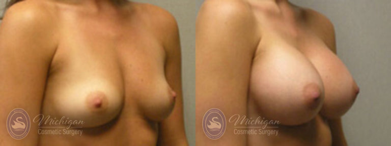 Breast Augmentation Before and After Photo by Dr. Awada in Southfield Michigan