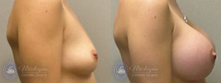 Breast Augmentation Before and After Photo by Dr. Awada in Southfield Michigan