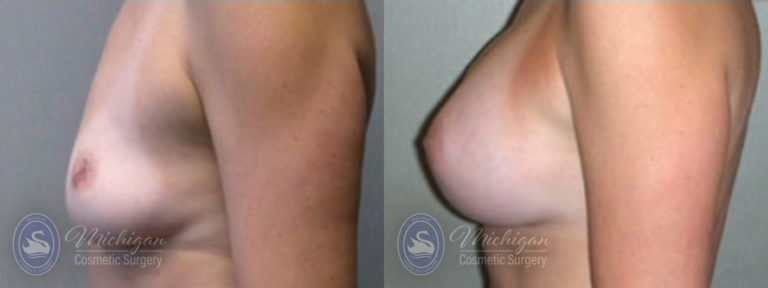 Breast Augmentation Before and After Photo by Dr. Awada in Southfield Michigan