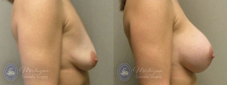 Breast Augmentation Before and After Photo by Dr. Awada in Southfield Michigan