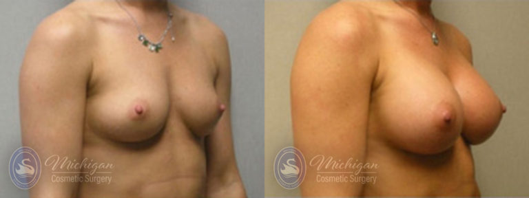 Breast Augmentation Before and After Photo by Dr. Awada in Southfield Michigan