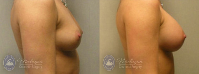 Breast Augmentation Before and After Photo by Dr. Awada in Southfield Michigan