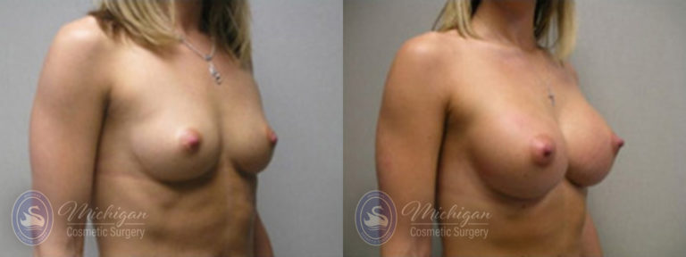 Breast Augmentation Before and After Photo by Dr. Awada in Southfield Michigan