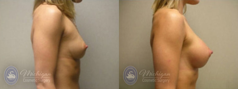 Breast Augmentation Before and After Photo by Dr. Awada in Southfield Michigan