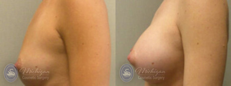 Breast Augmentation Before and After Photo by Dr. Awada in Southfield Michigan