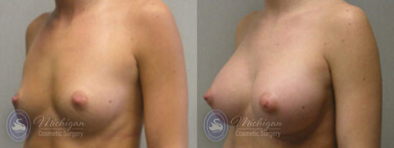 Breast Augmentation Before and After Photo by Dr. Awada in Southfield Michigan