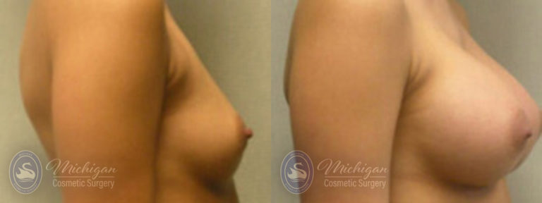 Breast Augmentation Before and After Photo by Dr. Awada in Southfield Michigan