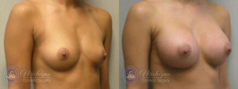 Breast Augmentation Before and After Photo by Dr. Awada in Southfield Michigan