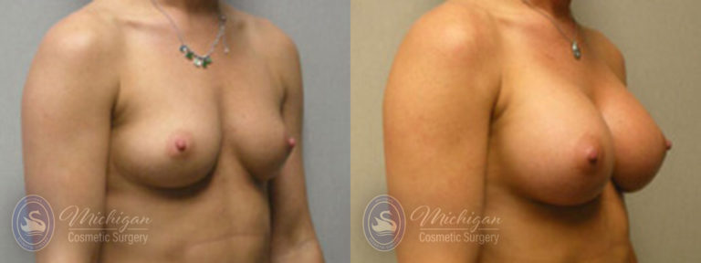Breast Augmentation Before and After Photo by Dr. Awada in Southfield Michigan