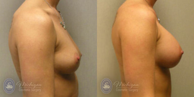 Breast Augmentation Before and After Photo by Dr. Awada in Southfield Michigan