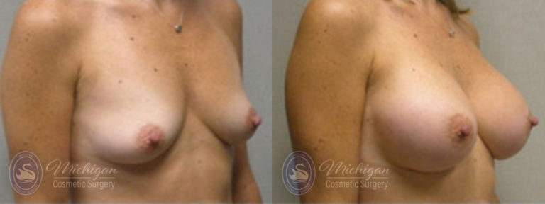Breast Augmentation Before and After Photo by Dr. Awada in Southfield Michigan