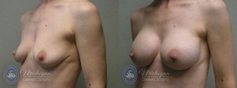 Breast Augmentation Before and After Photo by Dr. Awada in Southfield Michigan