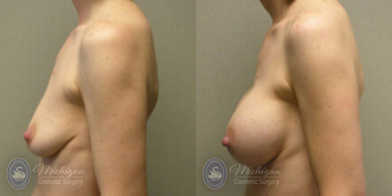 Breast Augmentation Before and After Photo by Dr. Awada in Southfield Michigan