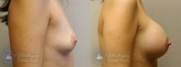 Breast Augmentation Before and After Photo by Dr. Awada in Southfield Michigan