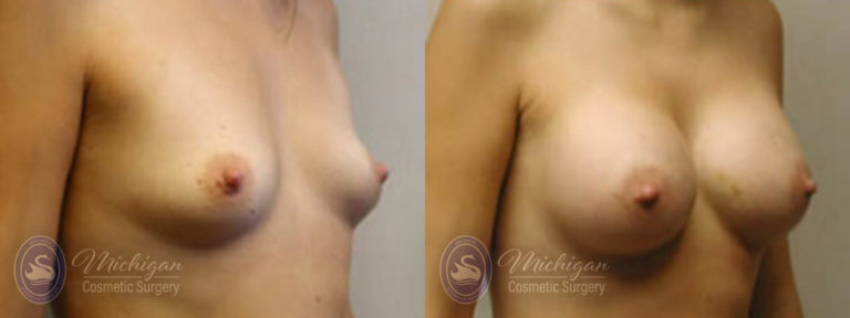 Breast Augmentation Before and After Photo by Dr. Awada in Southfield Michigan