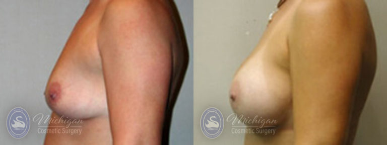 Breast Augmentation Before and After Photo by Dr. Awada in Southfield Michigan